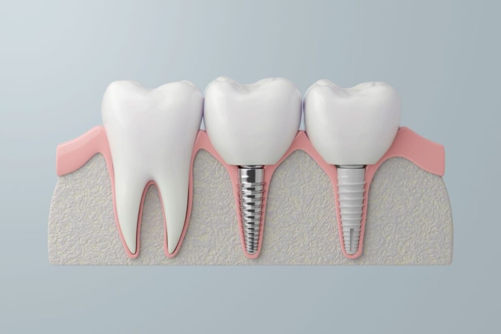 Comparație ilustrată 3D între tipurile de implanturi din titan si zirconiu pentru implanturi dentare.