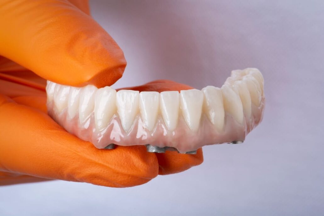 Mana cu manusa portocalie tine coroane din zirconiu pe bară de titan, pe fundal alb. Restaurare protetică totală pe implanturi dentare.