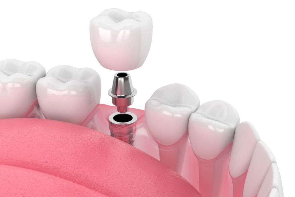 bont protetic utilizat in implant dentar