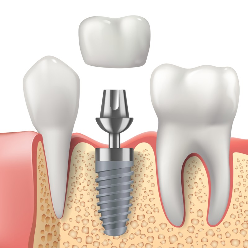 componente implant dentar 