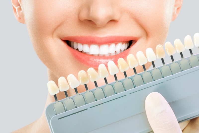 imagine cu o lucrare dentară estetică