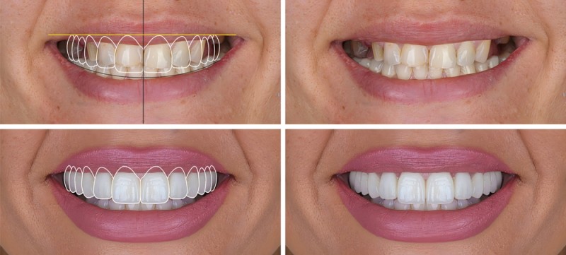 exemplu de lucrare realizata cu Digital Smile Design