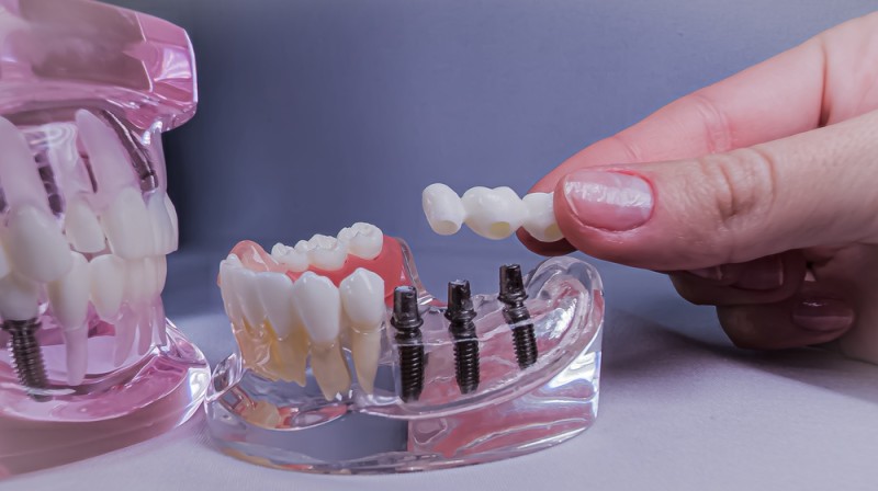 Imaginile arată diferite tipuri de implanturi dentare