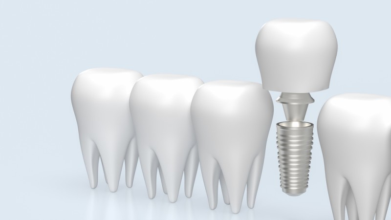 materiale dentare biocompatibile