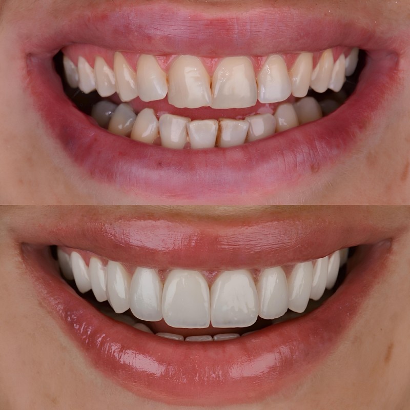 Comparatie inainte si dupa aplicarea fatetelor dentare, cu imbunatatirea formei si alinierii dintilor.