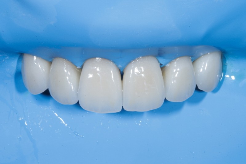 fatete dentare din disilicat de litiu