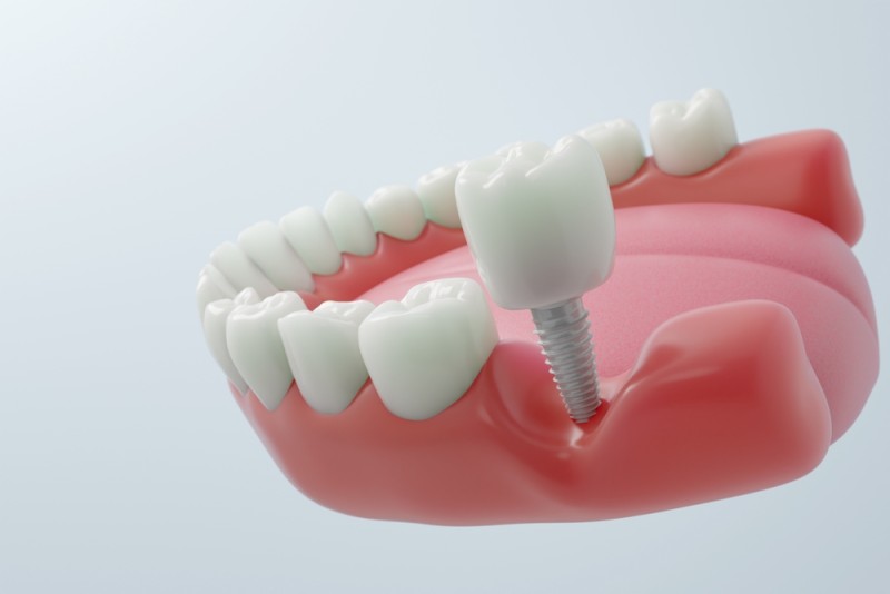 fatete dentare din disilicat de litiu